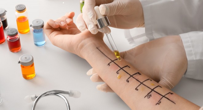 Alerji testlerine erişimde eşitsizlik