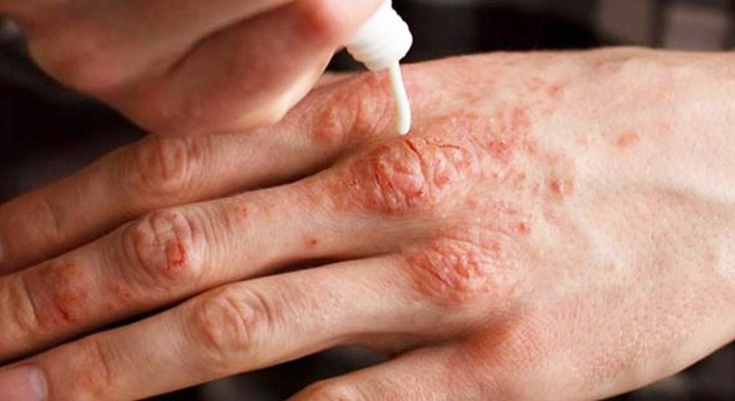 Ciltte kaşıntı ve kızarıklığa dikkat