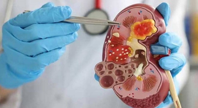 Çocuklarda ateşin nedeni böbrek olabilir