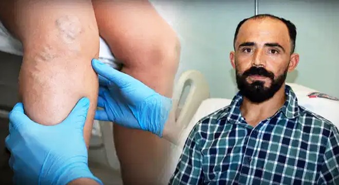 Sedef hastalığı nedeniyle atardamarı yırtıldı