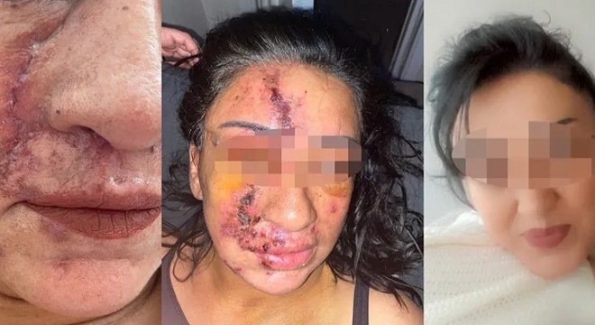 Yine estetik faciası